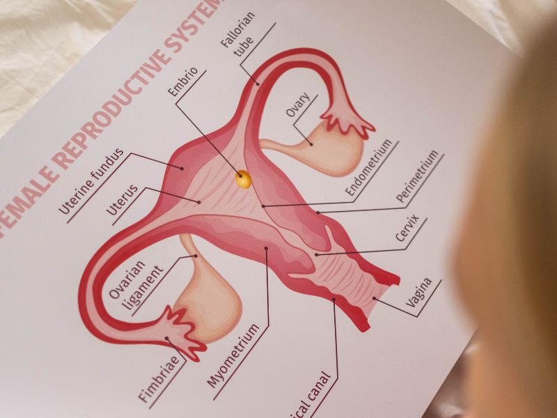 Obat malaria ditemukan efektif atasi gejala PCOS